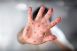 هشدار وزارت بهداشت درباره شیوع سرخک / فراخوان واکسیناسیون کودکان ایرانی و مهاجر زیر ۵ سال